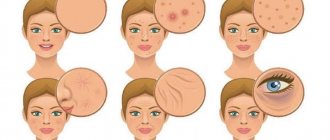 how to remove acne inflammation on face