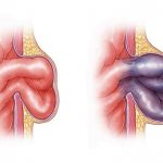 Как выглядит шов после удаления пупочной грыжи. Курс восстановления после операции на пупочной грыже
