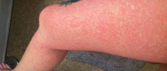 How to cure cold urticaria