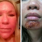 What side effects are not normal after procedures?