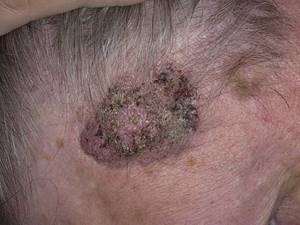 Кератоз кожи. Фото у взрослых на лице, теле. Причины, стадии, симптомы и лечение