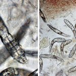 Клещи демодекс