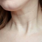 Кольца венеры на шее. Что означают, как убрать, причины, фото