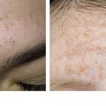 Комедоны и милиумы (черные и белые прыщи)