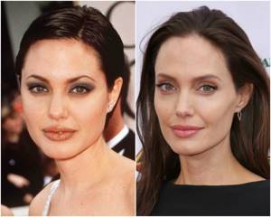 Комки Биша - до и после - Анджелина Джоли