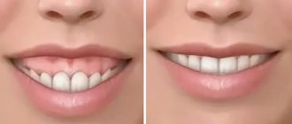 Коррекция десневой улыбки в клинике Градиент
