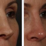 Костная мозоль после ринопластики: описание с фото, причины появления, методы и способы для удаления мозоли, рекомендации хирургов