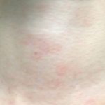 Красные чешущиеся пятна на шее возникают как следствие развития аллергии