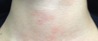 Красные чешущиеся пятна на шее возникают как следствие развития аллергии