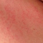 Красные пятна на ногах: что они значат и что делать?