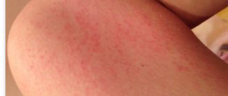 Красные пятна на ногах: что они значат и что делать?