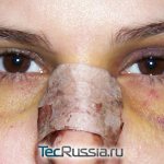 large bruises under the eyes after rhinoplasty