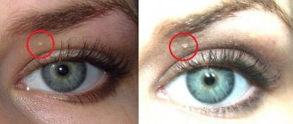 Ксантелазма век