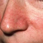 Cuperosis is not a disease, but it can progress. To avoid getting a red nose, it is worth starting treatment for spider veins in a timely manner. 