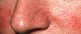Купероз не заболевание, но может прогрессировать. Чтобы не получить красный нос, стоит своевременно начать лечение от сосудистых звездочек.