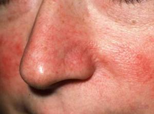 Купероз не заболевание, но может прогрессировать. Чтобы не получить красный нос, стоит своевременно начать лечение от сосудистых звездочек.