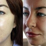 Лазерная наноперфорация