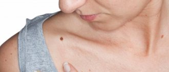 лечение доброкачественной опухоли кожи