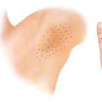 treatment of local hyperhidrosis with Botox injections