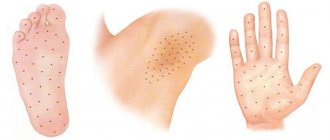 treatment of local hyperhidrosis with Botox injections