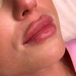 Липофилинг губ – что это такое