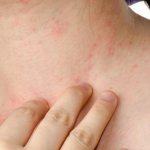 локализация сыпи на коже