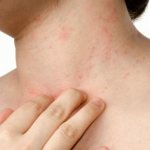 Мазь от зуда покраснения и шелушения кожи. Противозудные препараты в дерматологии 02