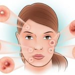 Мелкие гнойные прыщики на лице у женщин. Причины и лечение, как избавиться