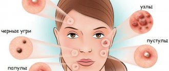 Мелкие гнойные прыщики на лице у женщин. Причины и лечение, как избавиться