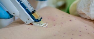 Mesotherapy for the spine: what it looks like, medications, traditional medicine recipes, what it is