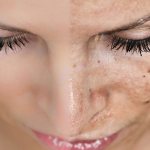 мезотерапия от пигментации