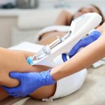 Mesotherapy for stretch marks