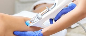 Mesotherapy for stretch marks