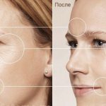 Морщины до нанесения крема и после