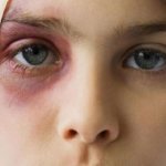 A bruise appeared on the chin without a blow