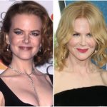 Nicole Kidman before and after plastic surgery