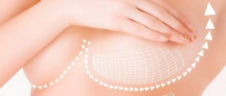 Нитевая подтяжка груди: суть, эффект, противопоказания