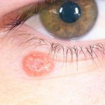 новообразование на веке