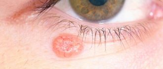 neoplasm on the eyelid