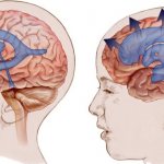 Одутловатость лица. Причины какого заболевания, как избавиться. Фото, лечение
