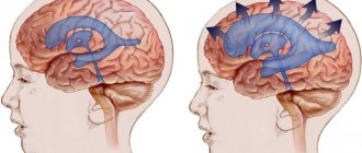 Одутловатость лица. Причины какого заболевания, как избавиться. Фото, лечение