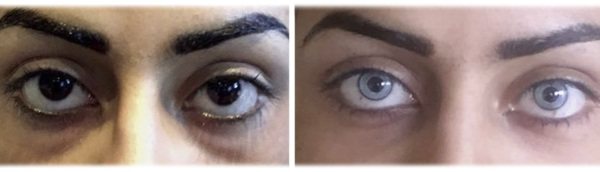 Операция по изменению цвета глаз лазером. Фото до и после, цена