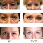 Ориентальная блефаропластика