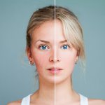 Основные принципы лечения розацеа