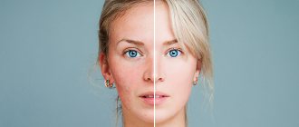 Basic principles of rosacea treatment