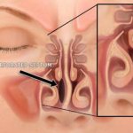 перфорация носовой перегородки