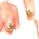 периареолярная мастопексия