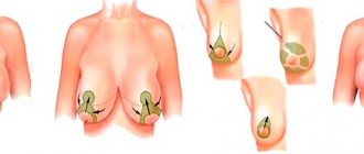 periareolar mastopexy