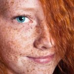 Пигментная ксеродерма