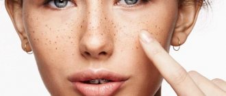 Пигментные пятна на лице. Как убрать, отбелить кожу в домашних условиях. Лечение народными средствами